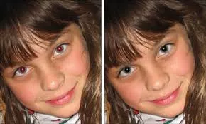 removecao olhos vermelhos
